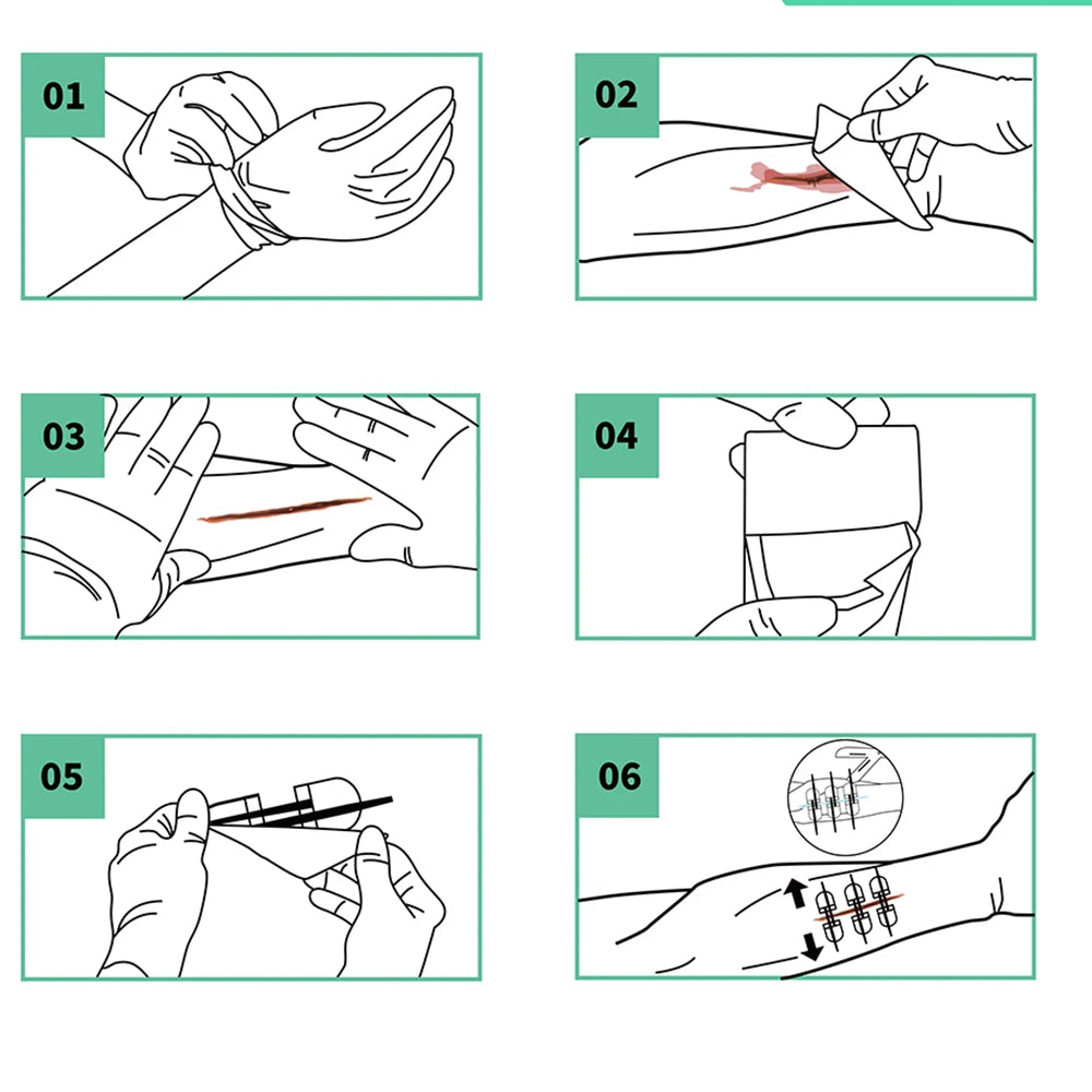 Rhino Rescue Emergency Wound Closure Strip Kit Laceration Repair